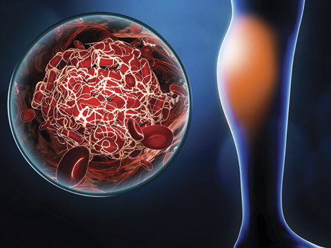 05258 polmonary embolism2 480