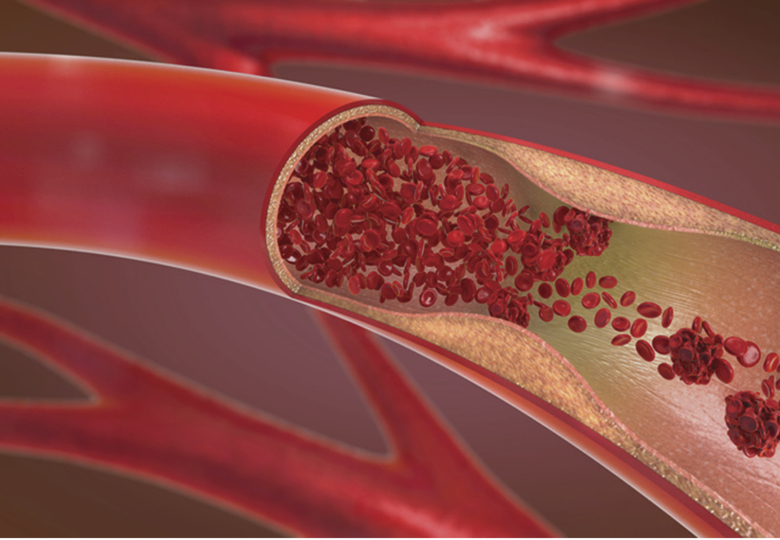 05258 pulmonary embolism1 780