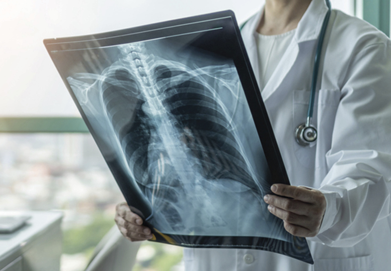 chronic broncho pneumo 2 780